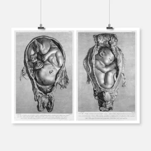 Dissection of a Pregnant Uterus Poster